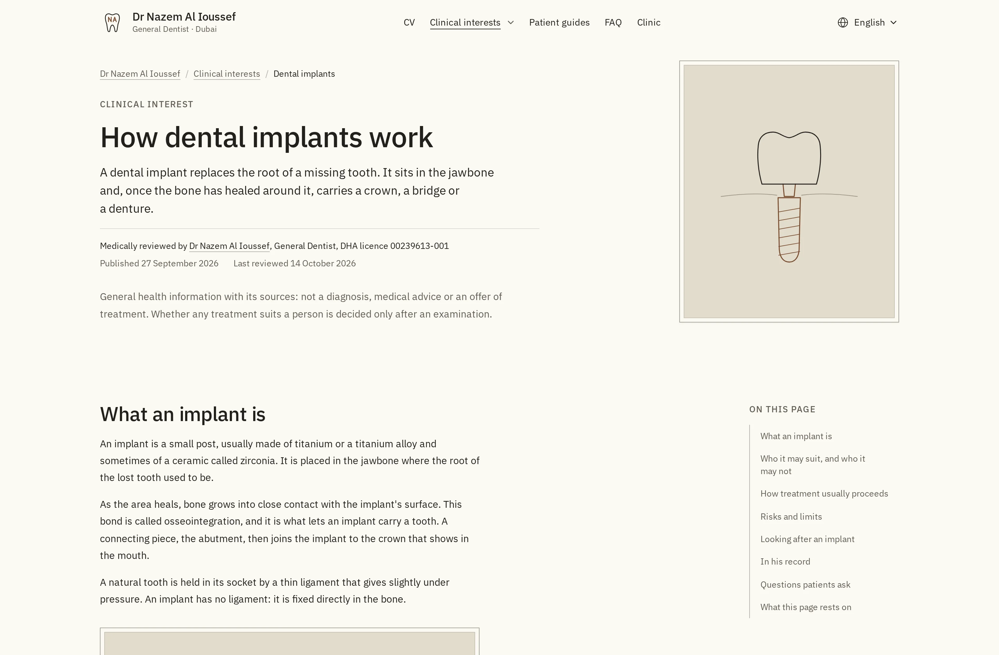 Dental implant sayfası: klinik ilgi alanı, bir çizim ve kaynaklarıyla yalın bir dille anlatılmış